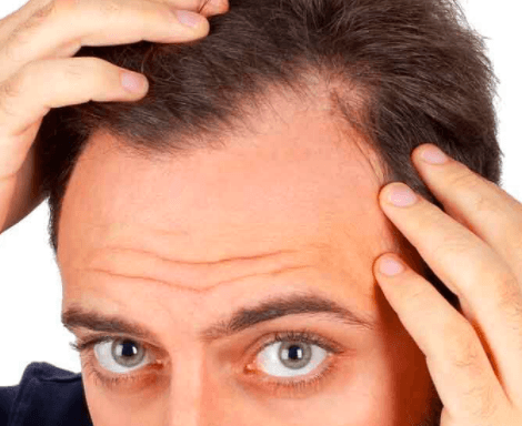 Are Men Giving Up On Hair Loss Treatments And Heading Straight For Transplants?